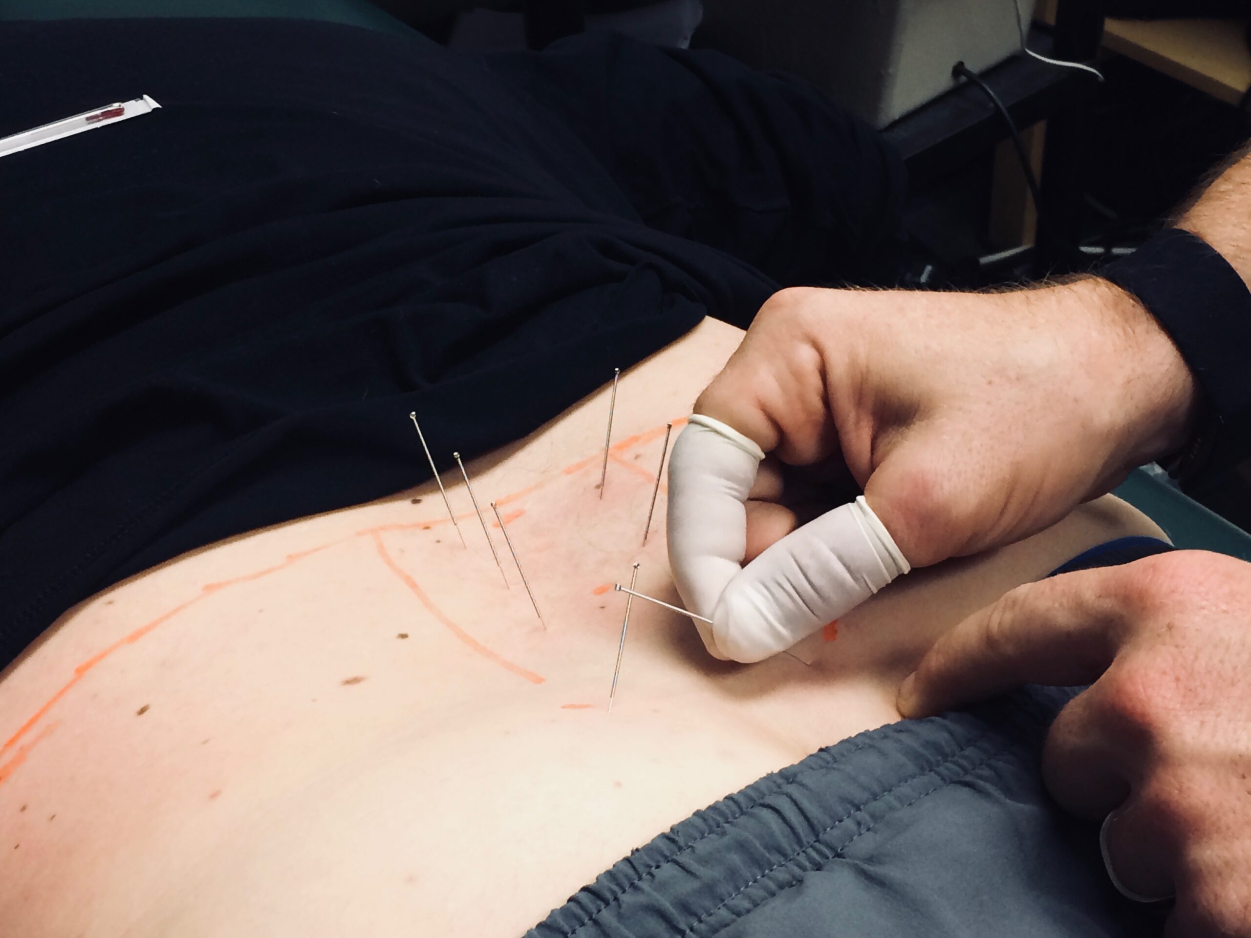 Dry Needling for Pelvic Health Dry Needling for Pelvic Health